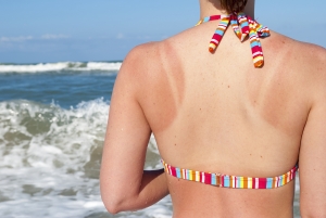 Sunburned woman at beach